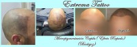 /album/micropigmentacion/tricopigmentacion-capilar-badajoz-1-jpg/